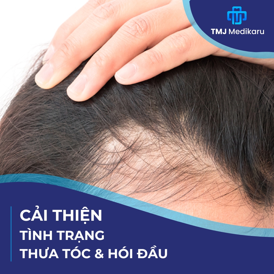 Công nghệ y học tái tạo trong việc cải thiện tình trạng thưa tóc và hói đầu